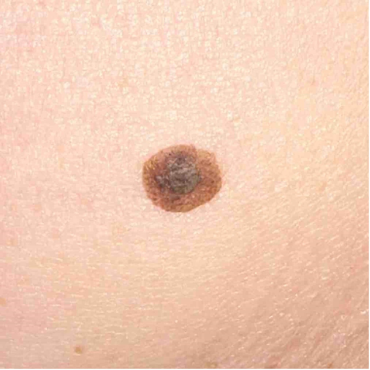 Seborrheic Keratosis